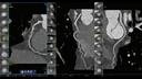Coronary CPR to show coronary heart disease.
