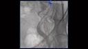 Minimally invasive treatment of prostatic hyperplasia.