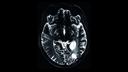 High resolution vascular imaging of a patient with brain tumor showing detailed visualization of the vasculature within and around the pathologically affected tissue. © FAU, Erlangen, Germany
