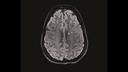 Anatomical image from a Multiple Sclerosis patient. The white matter lesion shows the central vein sign. © FAU, Erlangen, Germany