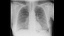 X-ray imaging for COVID-19 patients