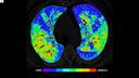 COVID-19 pneumonia - quantitative assessment