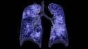 COVID-19 pneumonia