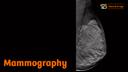 Screening mammography has come a long way, both in terms of organization and technology.