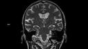 T2 TSE COR-MAGNETOM Sola/Coil-HeadNeck 20/Resolution-320/Scan Time-2:21/Aceleration-s2