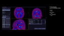 Biograph Vision clinical case