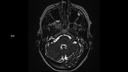 T2 SPACE AX-MAGNETOM Sola/Coil-HeadNeck 20/Resolution-640/Scan Time-4:38/Aceleration-p2
