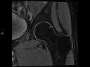 Coronal PD FS-MAGNETOM Lumina