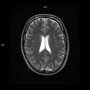 Axial T2-MAGNETOM Free.Max/Coil-HN12/Resolution-640/Scan Time-2:50/Aceleration-DRS