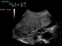 ACUSON P300 Ultrasound System - Abdominal - Liver Hemangioma