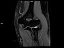 Coronal PD FS-MAGNETOM Lumina<br />