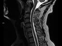 Sagittal T2 TSE-MAGNETOM Lumina/Coil-HeadNeck 20/Spine 24/Resolution-384/Scan Time-2:54