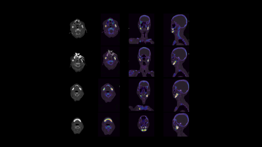 99mTc MDP SPECT/CT imaging in the evaluation of mandibular ...