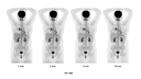 Biograph Vision clinical case