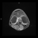 Axial PD FS-MAGNETOM Free.Max/Coil-Contour Small/Resolution-576/Scan Time-2:18/Aceleration-p2 s2 DRS