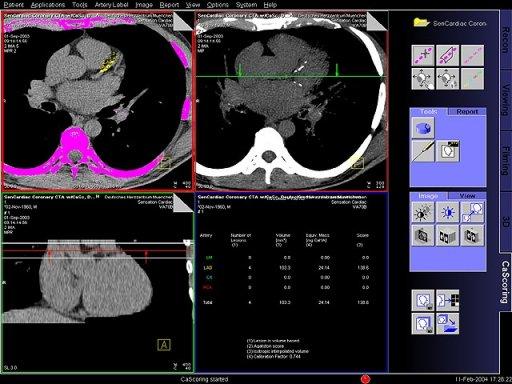 syngo Calcium Scoring