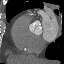 CT TAVR Planning