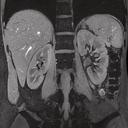 7T for abdominal imaging, T1 FLASH FatSat, 512 matrix with GRAPPA 2