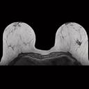 Breast, T1 3D FLASH, GRAPPA 2