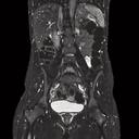 Abdomen, T2 3D SPACE IR, GRAPPA 2, 2 steps composed