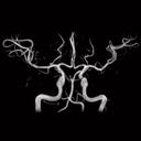 Head Angiography, 3D FLASH TOF MIP