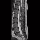 L-spine, T2 TSE, GRAPPA 2