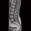 L-spine, T1 TSE, GRAPPA 2