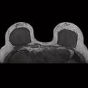 Breast, T1 3D FLASH. GRAPPA 2