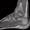 Ankle, PD 3D SPACE Restore, GRAPPA 2