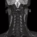 Neck, T2 TSE DIXON water, GRAPPA 2