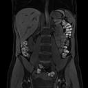 Abdomen, T1 3D VIBE FatSat, GRAPPA 3