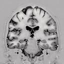 Head, T1 3D SPACE true Inversion Recovery, GRAPPA 2, isotropic