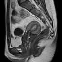 Pelvis female, T2 TSE, GRAPPA 2