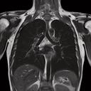 Thorax, T2 TSE, GRAPPA 2, with BLADE