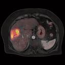 Hepatocellular carcinoma
