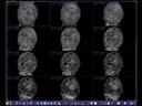 ACUSON S2000 ABVS - Women's Health - Volumetric