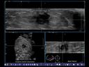 ACUSON S2000 ABVS - Women's Health - Volumetric