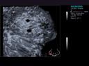 ACUSON S2000 ABVS - Women's Health - Volumetric