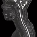 C-spine, T2 3D SPACE, GRAPPA 2