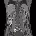 Abdomen, T1 3D VIBE FatSat, GRAPPA 3