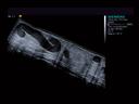 ACUSON S3000 Ultrasound System - Vascular - SieScape panoramic imaging