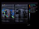 ACUSON S3000 Ultrasound System - Small Parts - Dual - Clarify vascular enhancement