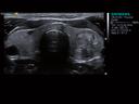 ACUSON S3000 Ultrasound System - Small Parts - HD Transducers - 18L6HD Transducer