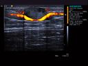 ACUSON S3000 Ultrasound System - Breast - Power Doppler - HD Transducers - 18L6HD Transducer