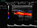 ACUSON P300 Ultrasound System - Vascular - Carotid Plaque – Color and PW Doppler