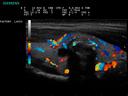 ACUSON P300 Ultrasound System - Small Parts - Thyroid Mass – Color Doppler
