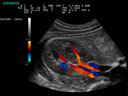 ACUSON P300 Ultrasound System - Abdominal - Renal Vasculature - Color Doppler