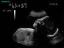 ACUSON P300 Ultrasound System - OB/GYN - Fetal Profile