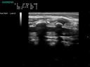 ACUSON P300 Ultrasound System - Pediatric - Neonatal Spine
