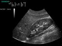 ACUSON P300 Ultrasound System - Abdominal - Liver-Kidney Interface